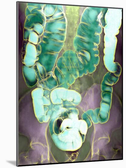 Large Intestine, X-ray-Du Cane Medical-Mounted Photographic Print