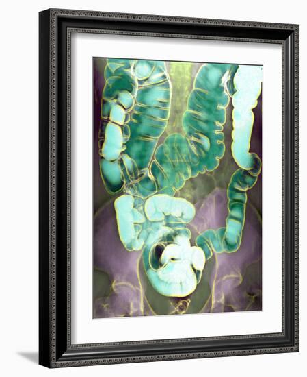 Large Intestine, X-ray-Du Cane Medical-Framed Photographic Print