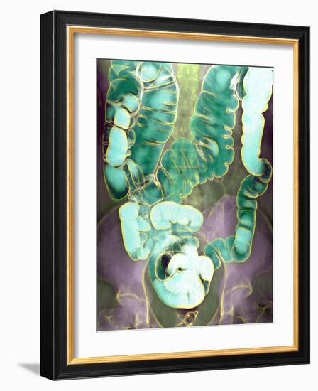 Large Intestine, X-ray-Du Cane Medical-Framed Photographic Print