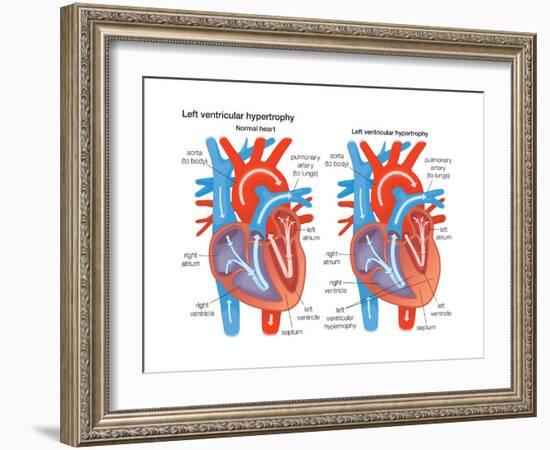 Left Ventricular Hypertrophy-Encyclopaedia Britannica-Framed Art Print