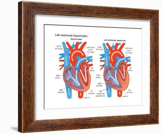 Left Ventricular Hypertrophy-Encyclopaedia Britannica-Framed Art Print