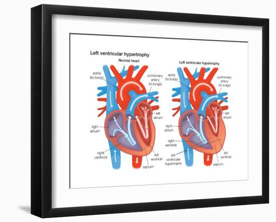 Left Ventricular Hypertrophy-Encyclopaedia Britannica-Framed Art Print