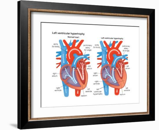 Left Ventricular Hypertrophy-Encyclopaedia Britannica-Framed Art Print