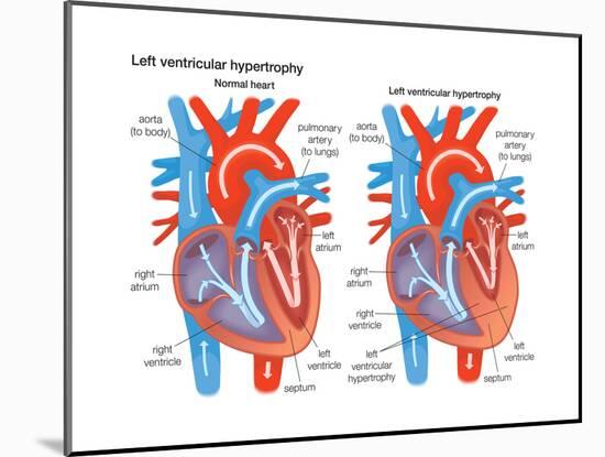 Left Ventricular Hypertrophy-Encyclopaedia Britannica-Mounted Art Print