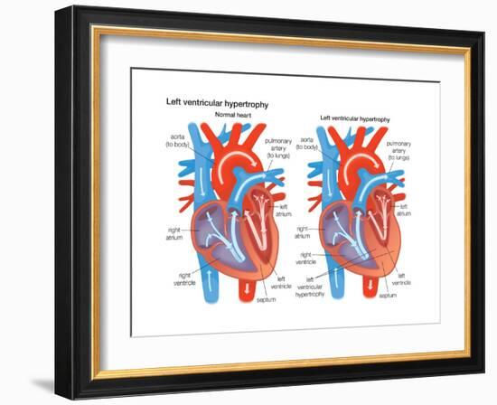 Left Ventricular Hypertrophy-Encyclopaedia Britannica-Framed Art Print