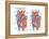 Left Ventricular Hypertrophy-Encyclopaedia Britannica-Framed Stretched Canvas