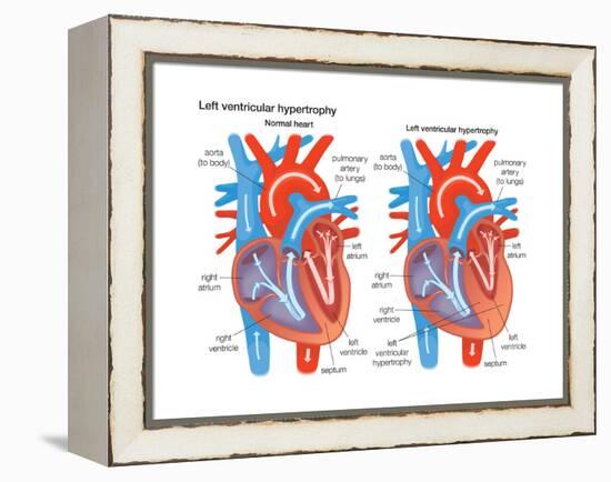 Left Ventricular Hypertrophy-Encyclopaedia Britannica-Framed Stretched Canvas