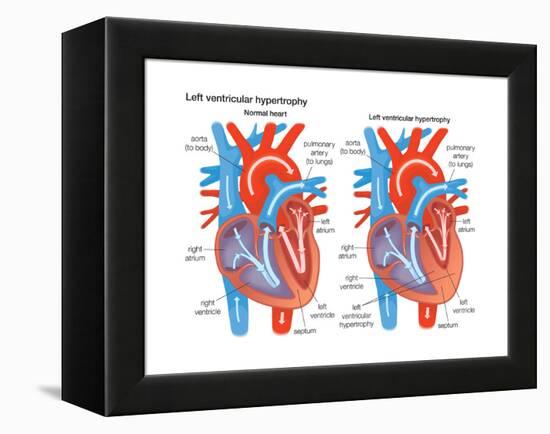 Left Ventricular Hypertrophy-Encyclopaedia Britannica-Framed Stretched Canvas