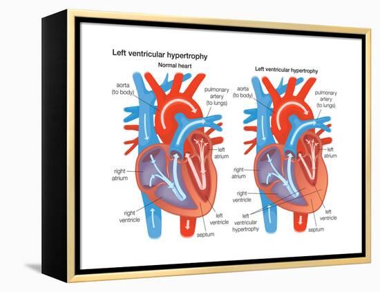 Left Ventricular Hypertrophy-Encyclopaedia Britannica-Framed Stretched Canvas