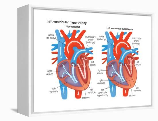 Left Ventricular Hypertrophy-Encyclopaedia Britannica-Framed Stretched Canvas