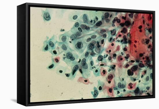 LM of a Cervical Smear Showing Moderate Dysplasia-Science Photo Library-Framed Premier Image Canvas