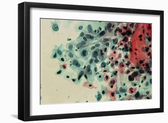 LM of a Cervical Smear Showing Moderate Dysplasia-Science Photo Library-Framed Photographic Print