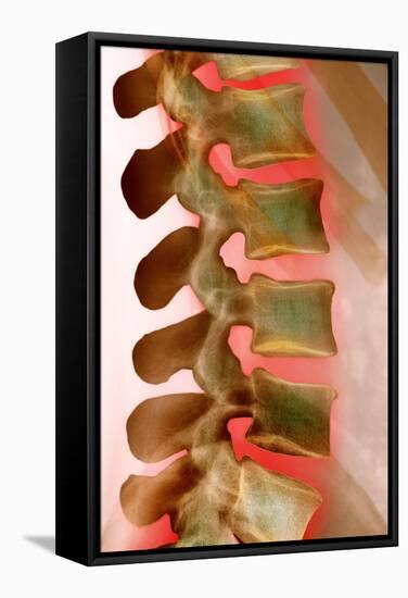 Lower Back Pain, X-ray-Science Photo Library-Framed Premier Image Canvas