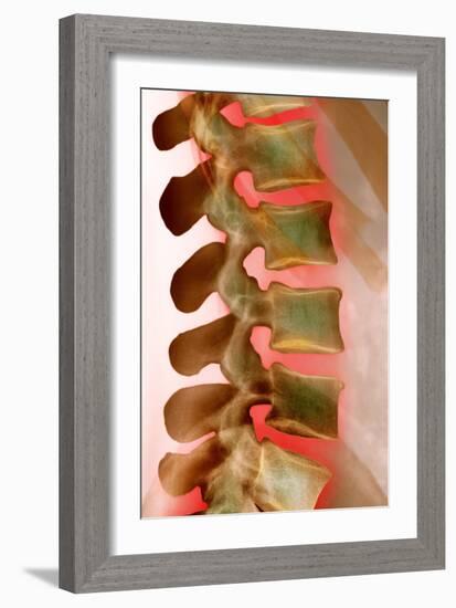 Lower Back Pain, X-ray-Science Photo Library-Framed Photographic Print