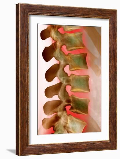 Lower Back Pain, X-ray-Science Photo Library-Framed Photographic Print