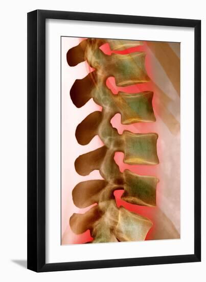 Lower Back Pain, X-ray-Science Photo Library-Framed Photographic Print