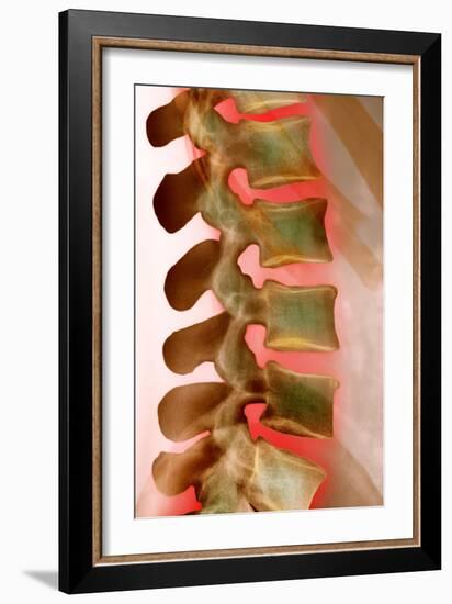 Lower Back Pain, X-ray-Science Photo Library-Framed Photographic Print