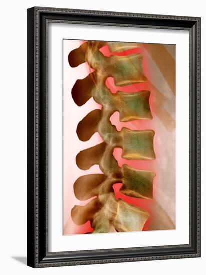 Lower Back Pain, X-ray-Science Photo Library-Framed Photographic Print