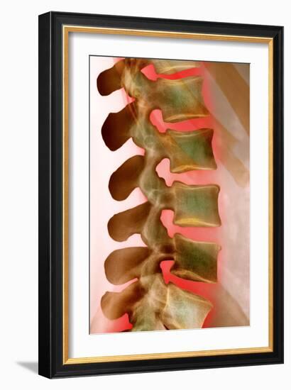 Lower Back Pain, X-ray-Science Photo Library-Framed Photographic Print