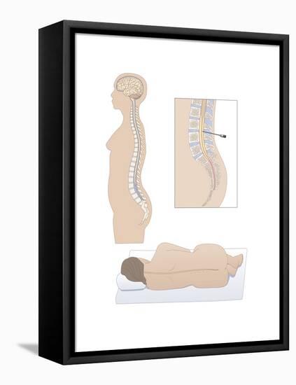 Lumbar Puncture, Artwork-Peter Gardiner-Framed Premier Image Canvas