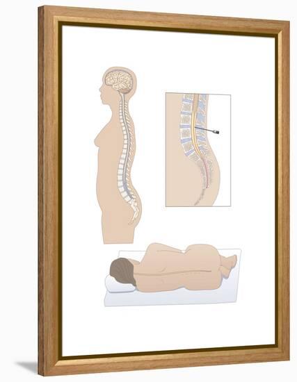 Lumbar Puncture, Artwork-Peter Gardiner-Framed Premier Image Canvas