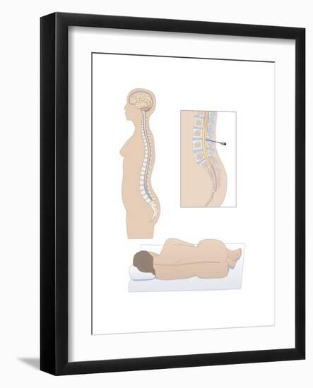 Lumbar Puncture, Artwork-Peter Gardiner-Framed Photographic Print