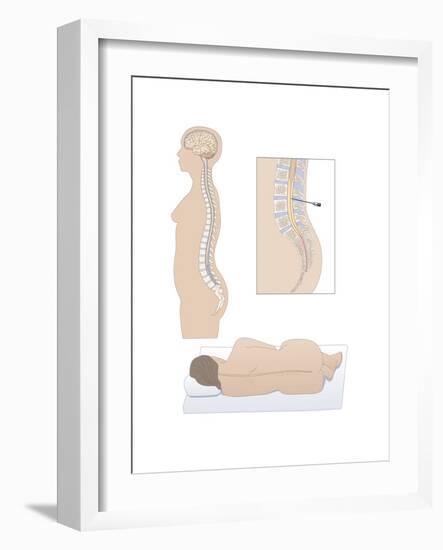 Lumbar Puncture, Artwork-Peter Gardiner-Framed Photographic Print