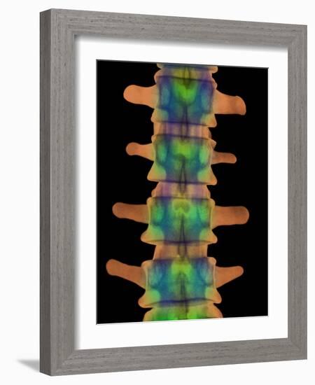 Lumbar Spine, X-ray-Science Photo Library-Framed Photographic Print