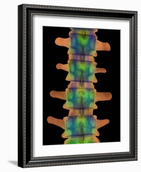 Lumbar Spine, X-ray-Science Photo Library-Framed Photographic Print