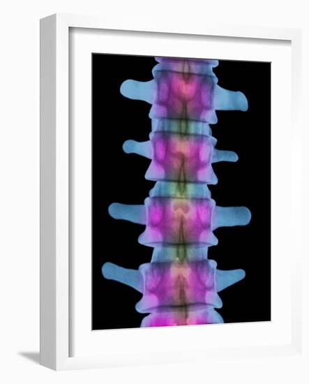 Lumbar Spine, X-ray-Science Photo Library-Framed Photographic Print