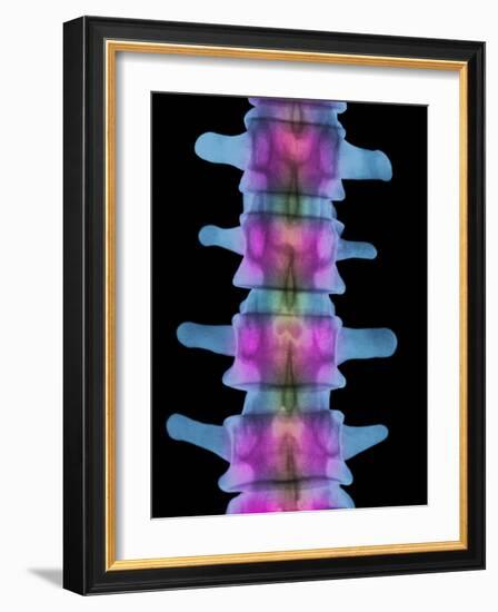 Lumbar Spine, X-ray-Science Photo Library-Framed Photographic Print