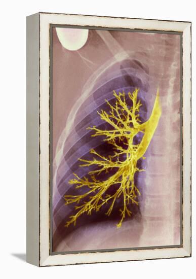 Lung Bronchioles, X-ray-null-Framed Premier Image Canvas