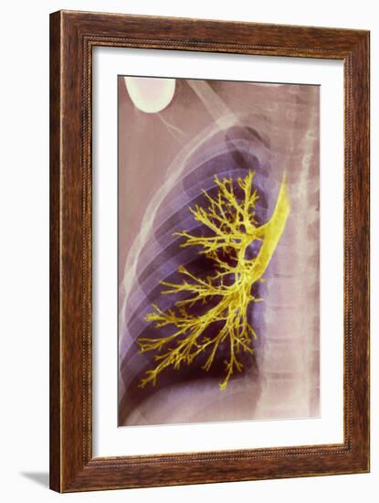 Lung Bronchioles, X-ray-null-Framed Photographic Print