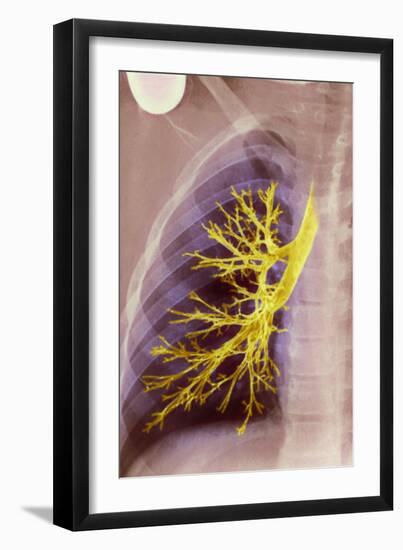 Lung Bronchioles, X-ray-null-Framed Photographic Print