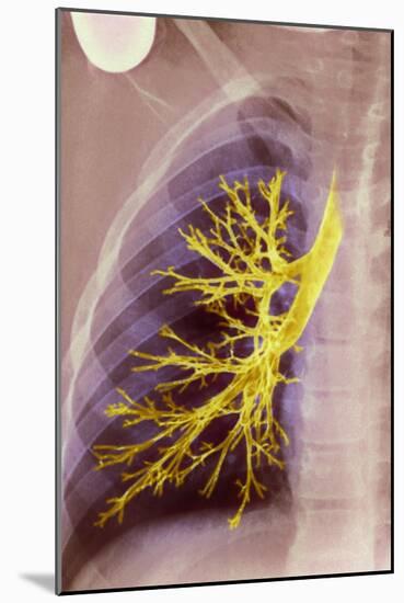 Lung Bronchioles, X-ray-null-Mounted Photographic Print