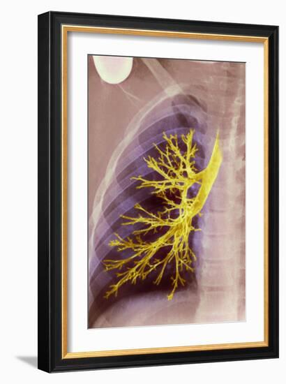 Lung Bronchioles, X-ray-null-Framed Photographic Print