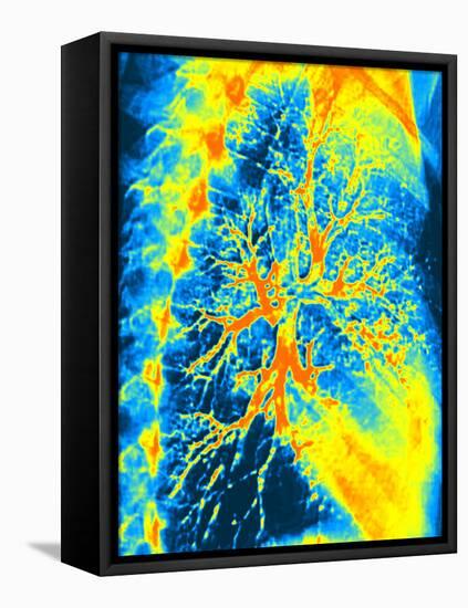 Lung Bronchogram, Coloured X-ray-PASIEKA-Framed Premier Image Canvas