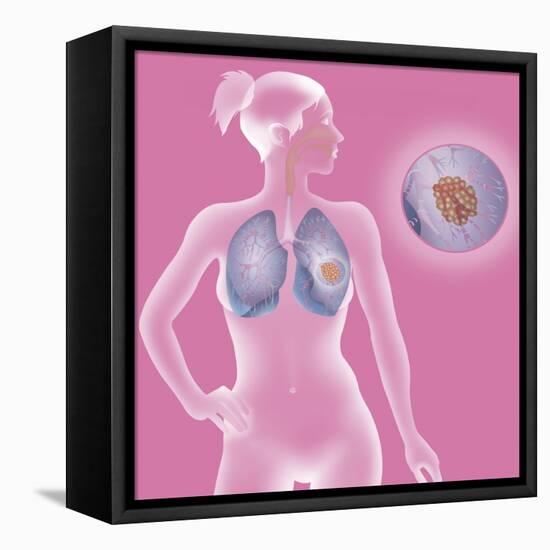 Lung Cancer, Drawing-Caroline Arquevaux-Framed Premier Image Canvas