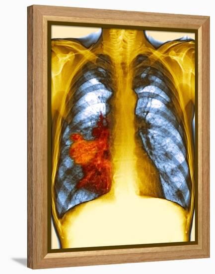 Lung Cancer, X-ray-Du Cane Medical-Framed Premier Image Canvas