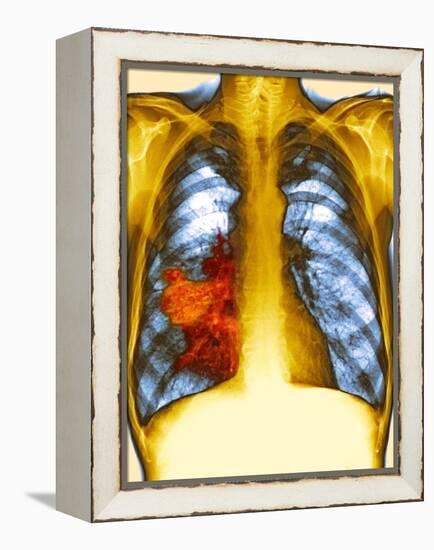 Lung Cancer, X-ray-Du Cane Medical-Framed Premier Image Canvas