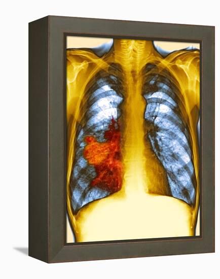 Lung Cancer, X-ray-Du Cane Medical-Framed Premier Image Canvas