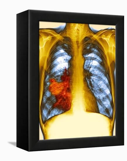 Lung Cancer, X-ray-Du Cane Medical-Framed Premier Image Canvas