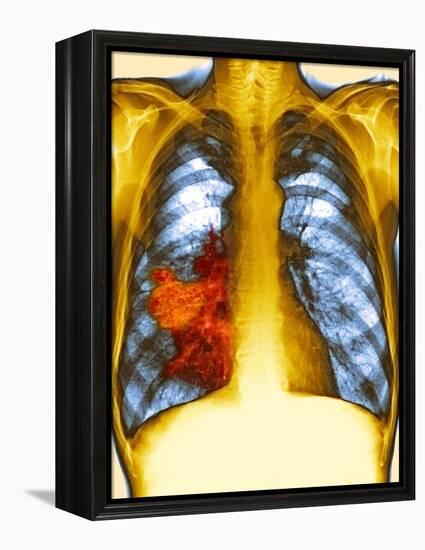 Lung Cancer, X-ray-Du Cane Medical-Framed Premier Image Canvas