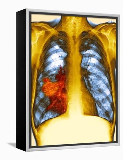 Lung Cancer, X-ray-Du Cane Medical-Framed Premier Image Canvas