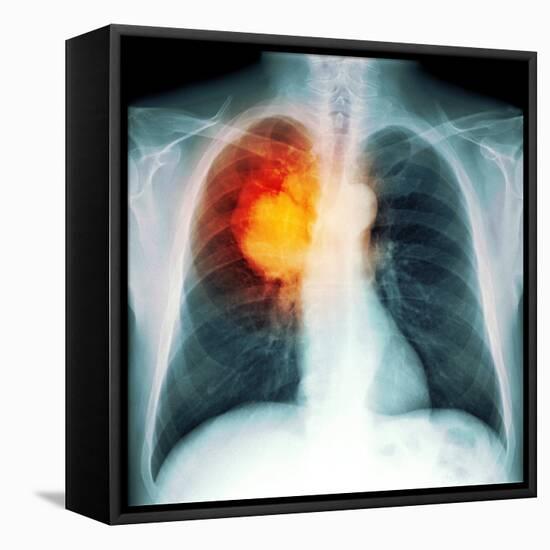 Lung Cancer, X-ray-Du Cane Medical-Framed Premier Image Canvas
