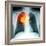 Lung Cancer, X-ray-Du Cane Medical-Framed Premium Photographic Print