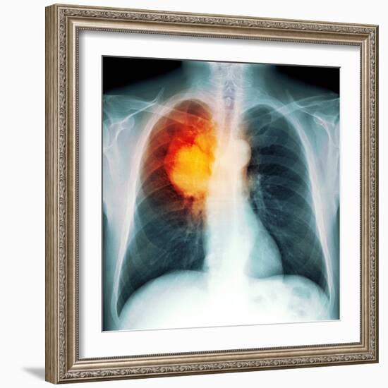 Lung Cancer, X-ray-Du Cane Medical-Framed Premium Photographic Print