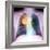 Lung Cancer, X-ray-Du Cane Medical-Framed Premium Photographic Print