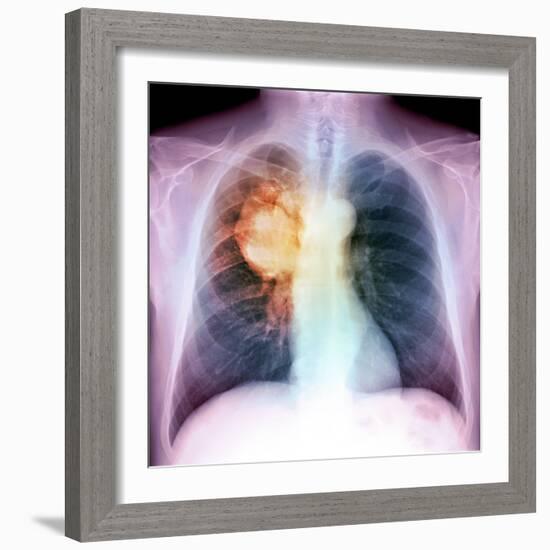 Lung Cancer, X-ray-Du Cane Medical-Framed Premium Photographic Print