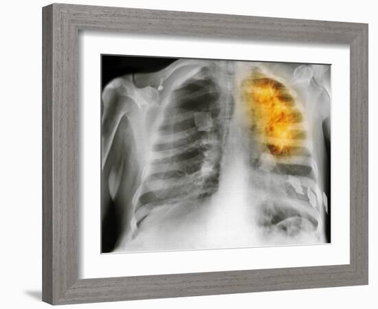 Lung Cancer, X-ray-Science Photo Library-Framed Photographic Print